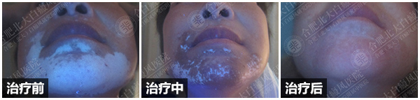 全省征集100名黑色素种植患者