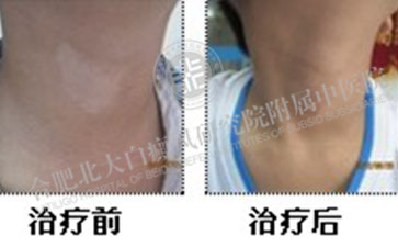 合肥北大，治疗效果好吗 