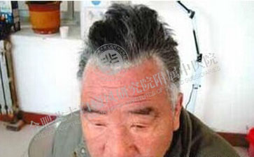 老年白癜风患者心理上该如何调节