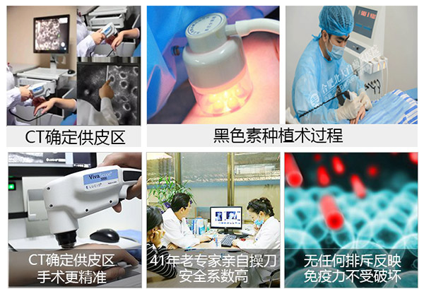 全省征集100名黑色素种植患者