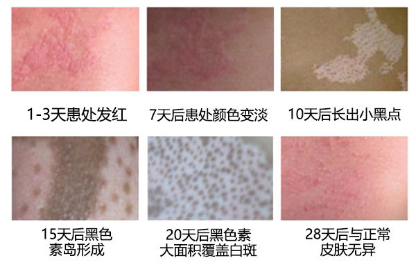 白癜风具体的症状有哪些呢