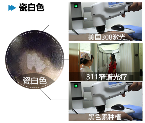 如何正确治疗白癜风？