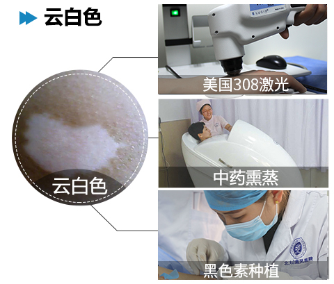 合肥女性要怎样医治白癜风