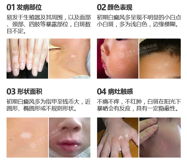 这些事白癜风症状出现的信号
