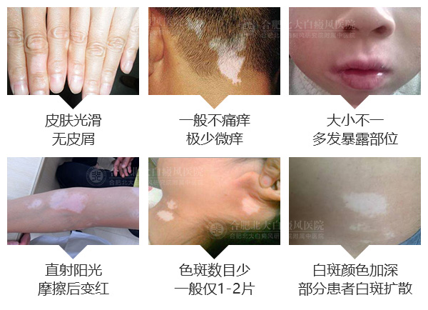 　白癜风发生后会出现哪些症状？