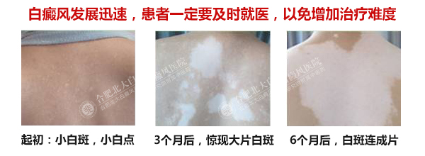 白癜风多久传播一次
