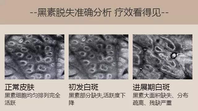 中医怎样医治白癜风