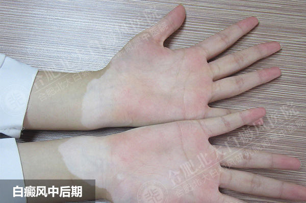 淮南手部白癜风怎么护理呢