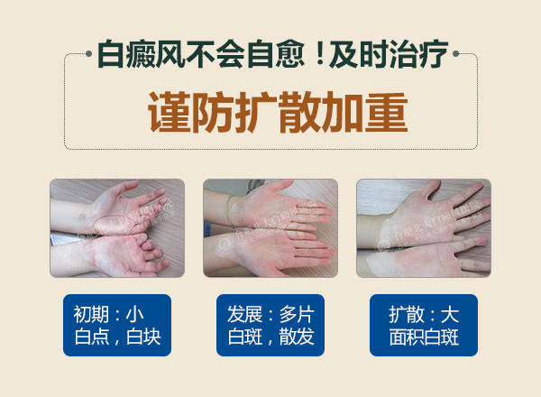 散发性白癜风的病因有哪些？