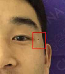 滁州眼眉部位的白癜风患者需要注意什么呢