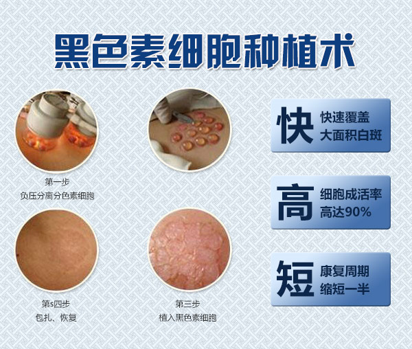 马鞍山黑色素细胞种植法—攻克皮肤白斑