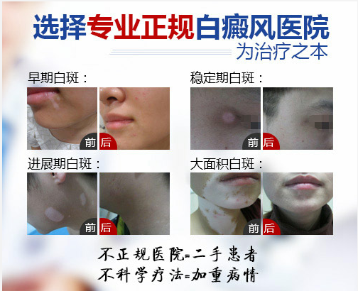 小面积白癜风怎么医治呢