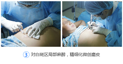 合肥孩子白癜风为什么要尽早治疗?