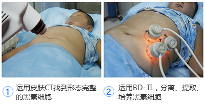 小孩子怎么会得白癜风?