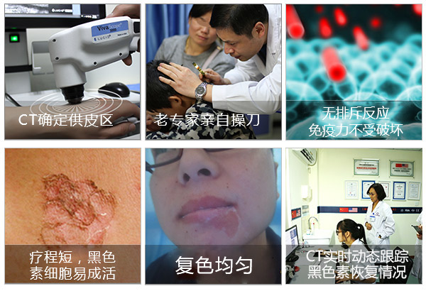 后天外伤导致的白癜风会遗传吗
