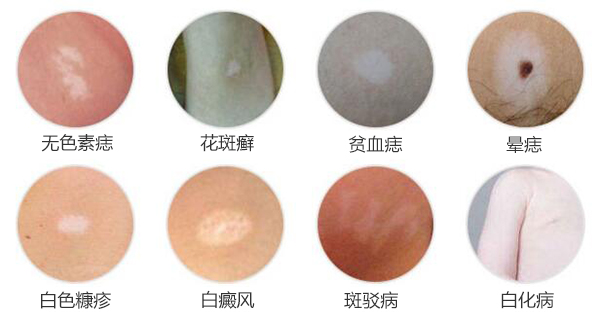每种类型的白癜风有什么特点？