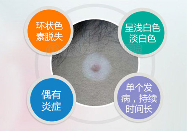 对白癜风不了解，你可以从这几个方面入手