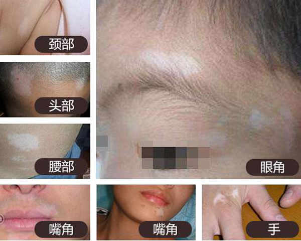 　白癜风有哪些症状？