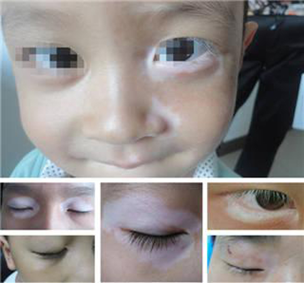淮南眼部白癜风对患者有什么危害