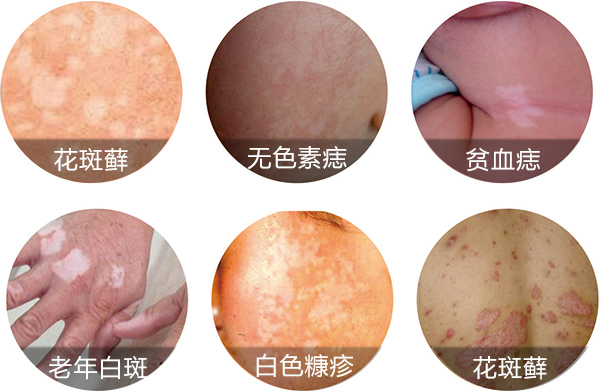 皮肤上为什么会产生白癜风?