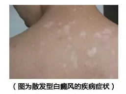 黄山脖子上患上白癜风会有哪些危害