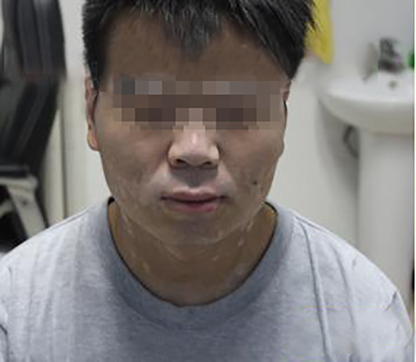 精神因素会诱发青少年白癜风出现吗?