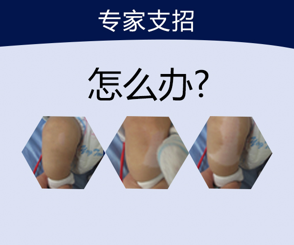 合肥怎样有效预防白癜风的发生