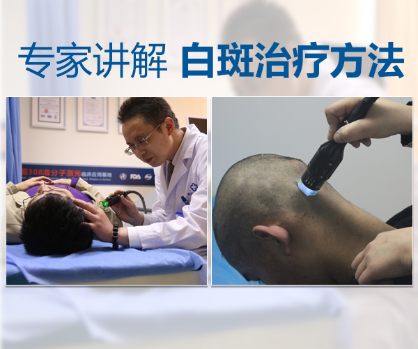 合肥医治白癜风的方法