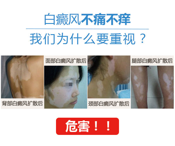 6月8日—9日南京皮研所候伟专家会诊白癜风危害