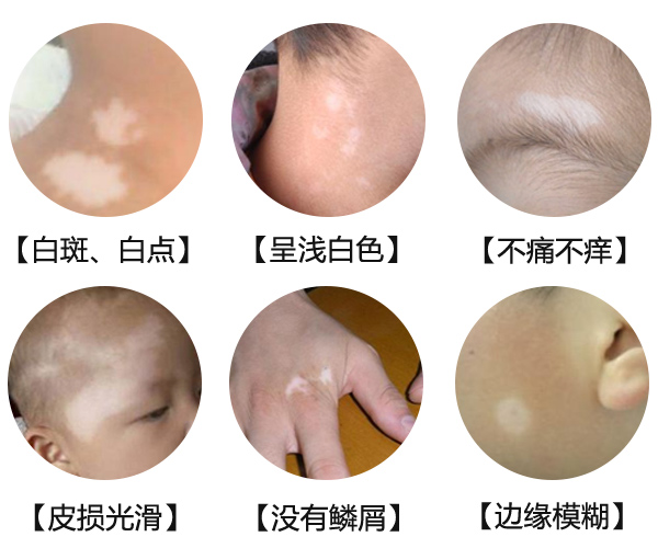 淮南白癜风患者夏季应该怎样护理