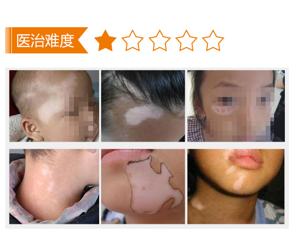 合肥儿童颈部白癜风症状表现是怎样的?