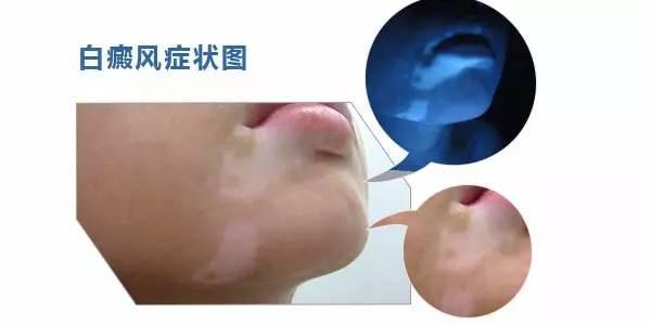 上海治疗白癜风：面部是儿童白癜风的高发部位