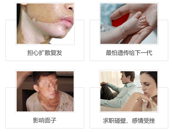 白癜风患者会脱发吗