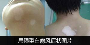 上海的白癜风医院，怎么护理脖子上的白斑
