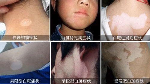 阜阳儿童白癜风治疗要注