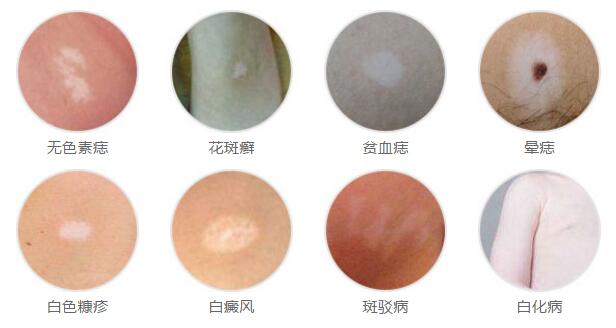 合肥北大白癜风新闻