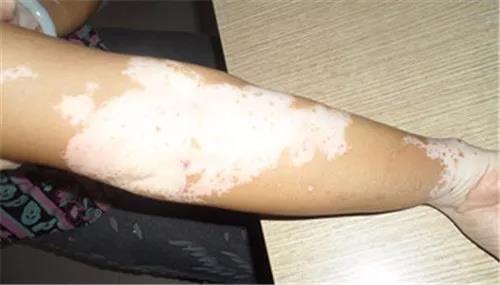 合肥白癜风同形反应科普资讯