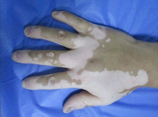 上海治疗白癜风医院，手背出现白斑是什么情况