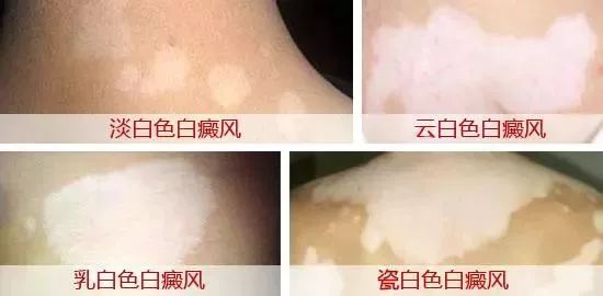 腰部的白癜风是什么样子的?