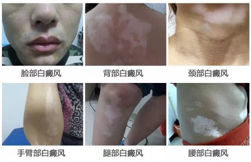 患上白癜风后皮肤有什么症状?