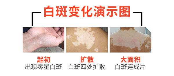 上海哪里可以治疗白癜风，面部白斑病患者如何防止病情扩散