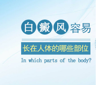 白癜风一般长在人体的哪个部位