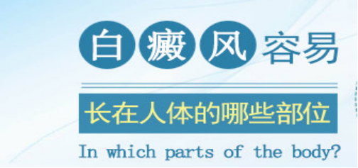 株洲白癜风容易出现在身体的哪些部位？