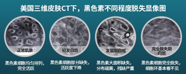 马鞍山皮肤CT—有辐射吗？