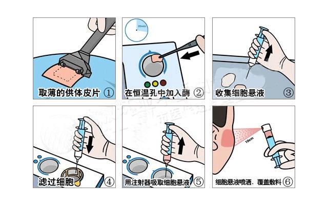 阜阳白癜风表皮移植术价格是多少？