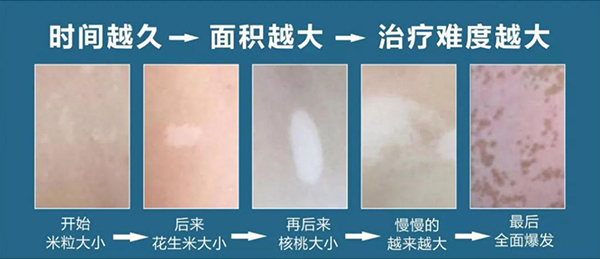 6月22-23日南京皮研所沈建平科普白癜风恶化