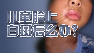 上海治疗白癜风医院，儿童如果患上白癜风该怎