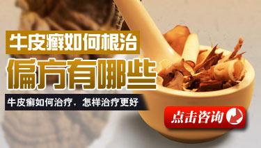 治疗牛皮癣使用偏方有效