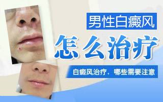 上海男性患上了白癜风的话要怎么去治疗?