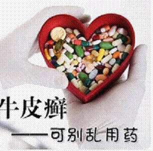 不同类型的牛皮癣治疗用药不同